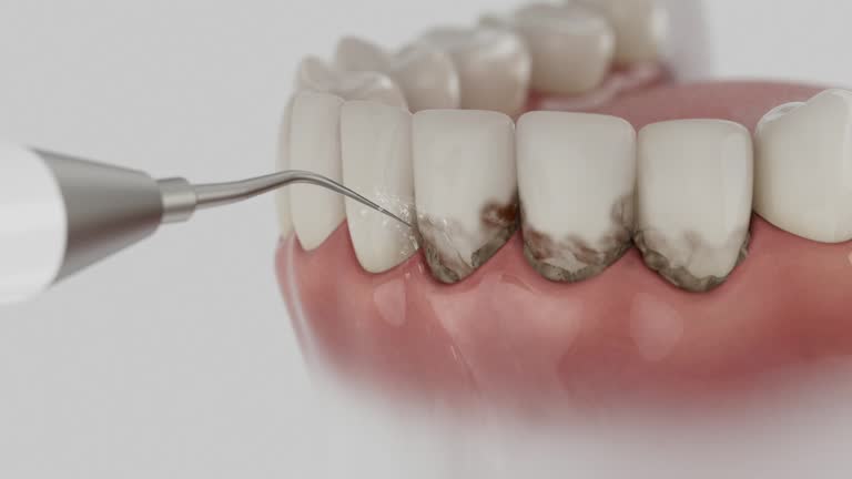 Trusted Wisdom Tooth Removal service in Brookings, SD - Dentist Open Now